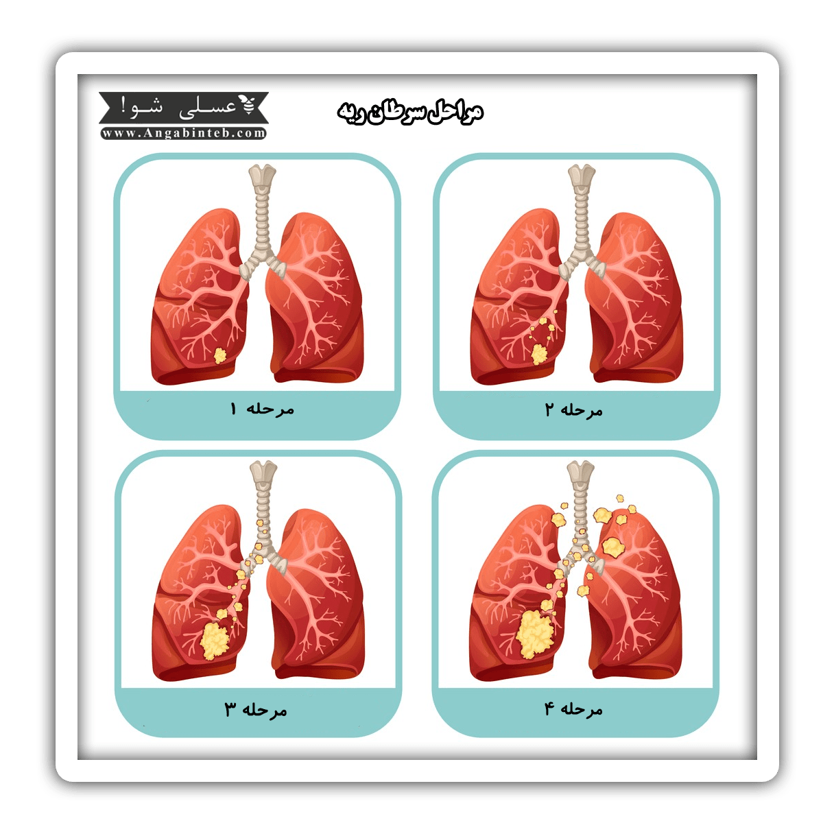 lung cancer-stages